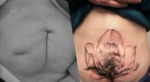 studio-tatouage-avignon-tatoueur-tatoueuse-graphicaderme-cover-cicatrice